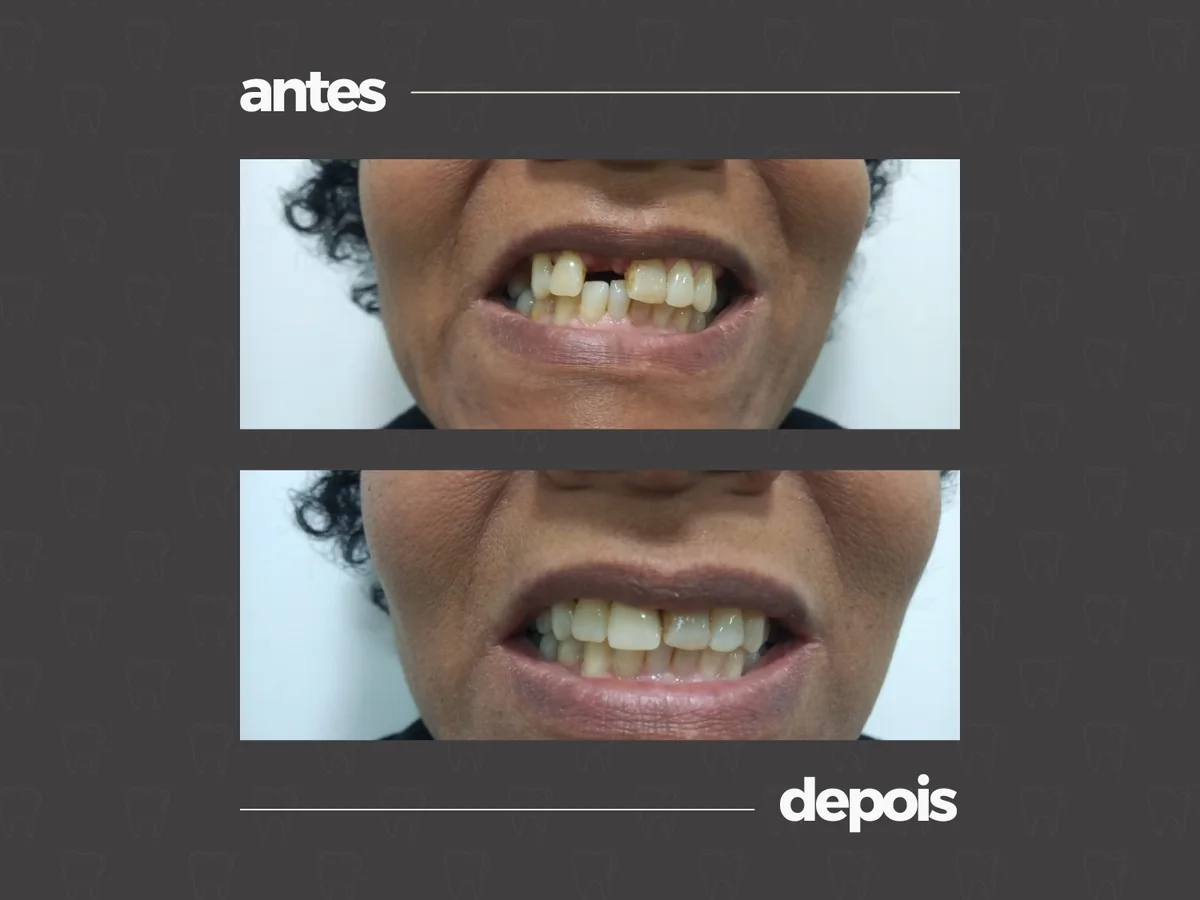 Comparativo clínico antes e depois, caso 3