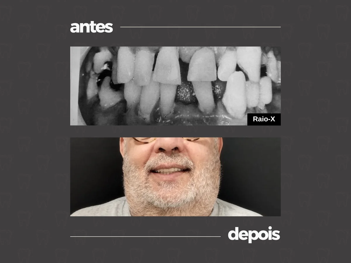 Comparativo clínico antes e depois, caso 4