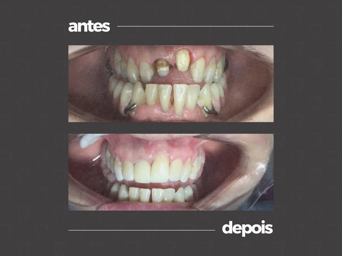 Comparativo clínico antes e depois, caso 8