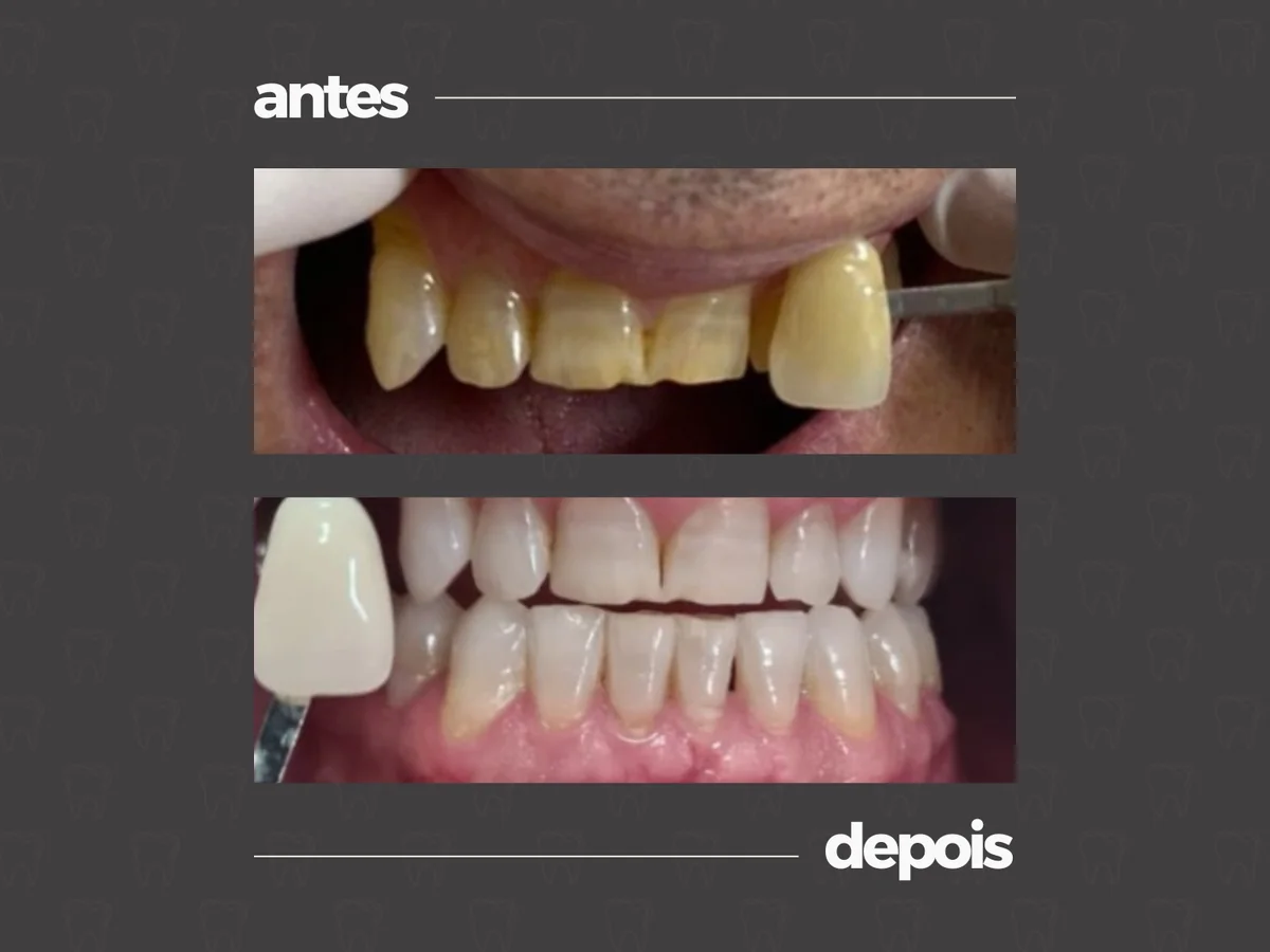 Comparativo clínico antes e depois, caso 9