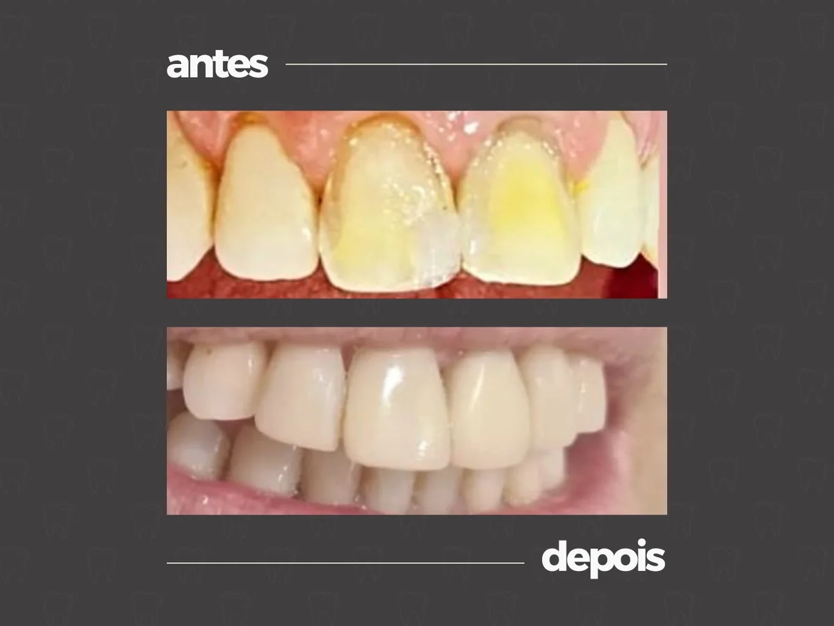 Comparativo clínico antes e depois, caso 11